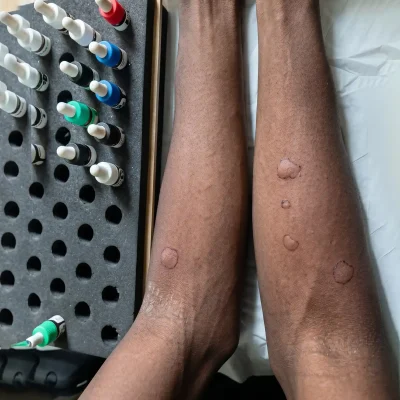 Allergo 1